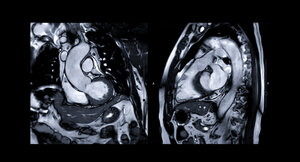 Imagerie par résonance magnétique cardiaque (IRM)