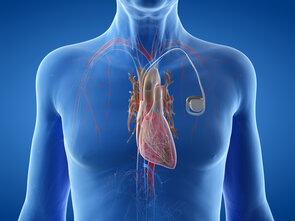 Implantation de stimulateur cardiaque